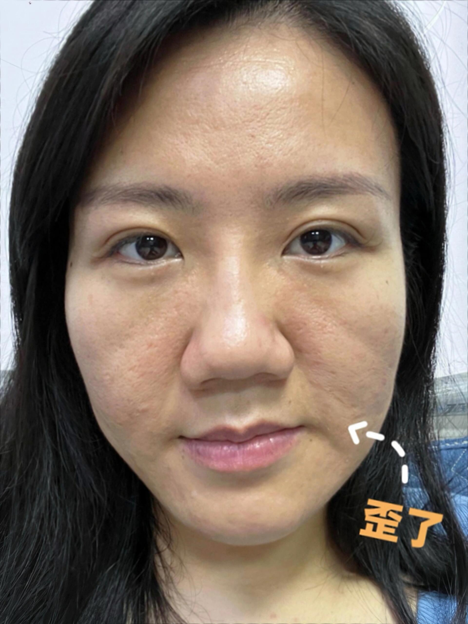 有多少人和我一样,大小脸,嘴歪  由于侧睡和单侧拒绝,感觉自己大小脸