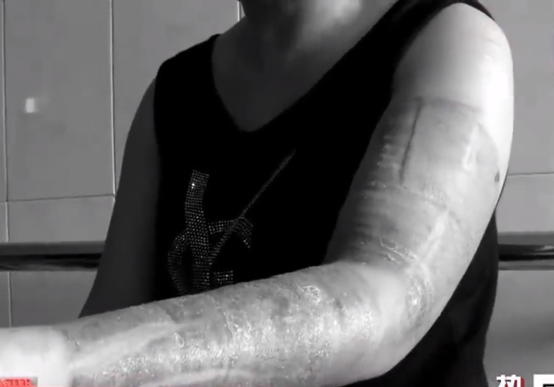 2015年河南男子跌入油锅,妻子为救他捐"人皮外衣",现在怎样了