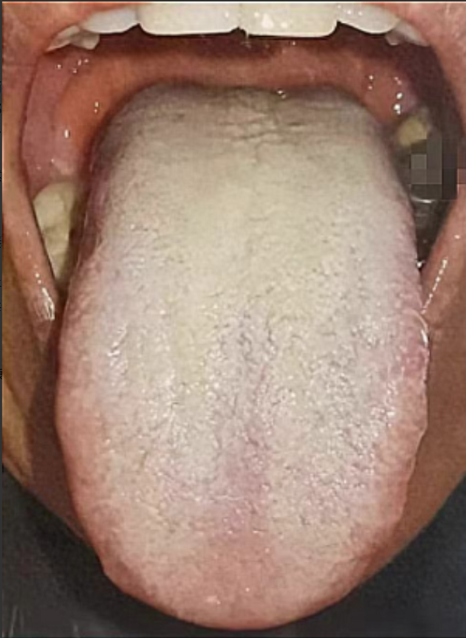 看这个舌象,尽管舌苔白腻如雪,但也别去健脾化痰湿!