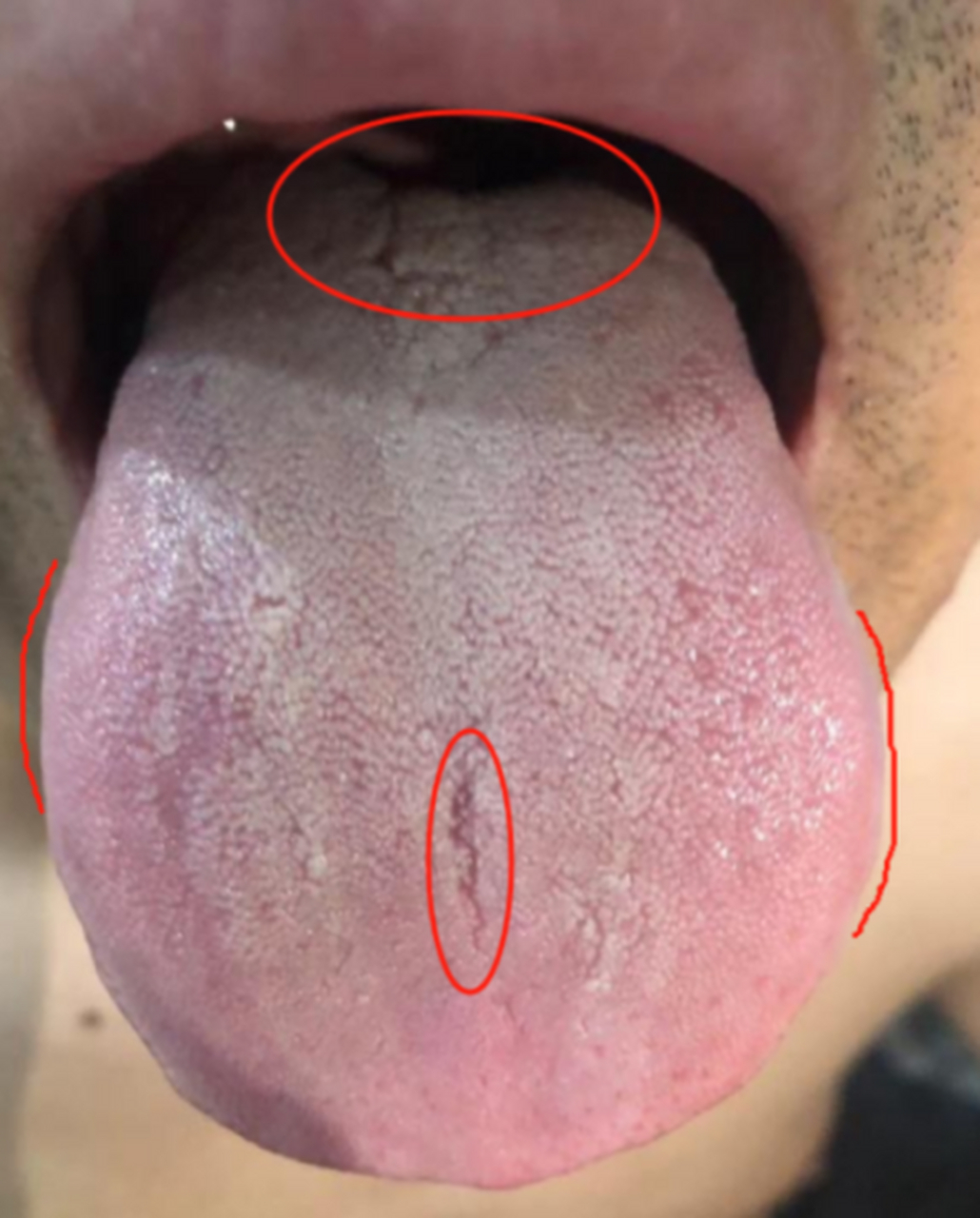 这种舌象,肾再虚,只要找对顺序,一调就见效 患者32岁,主诉:肾虚,那