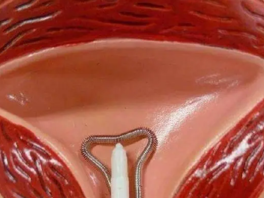 中国第一批"上环"的女性,30年后现状如何?医生:难逃4种结局