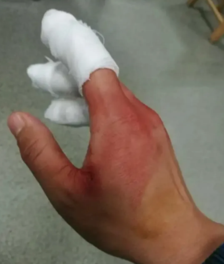 湖北仙桃一男子,打工时手指受伤,去了打工附近医院,缝8针收费1830元