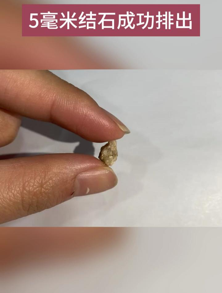 5毫米结石成功排出