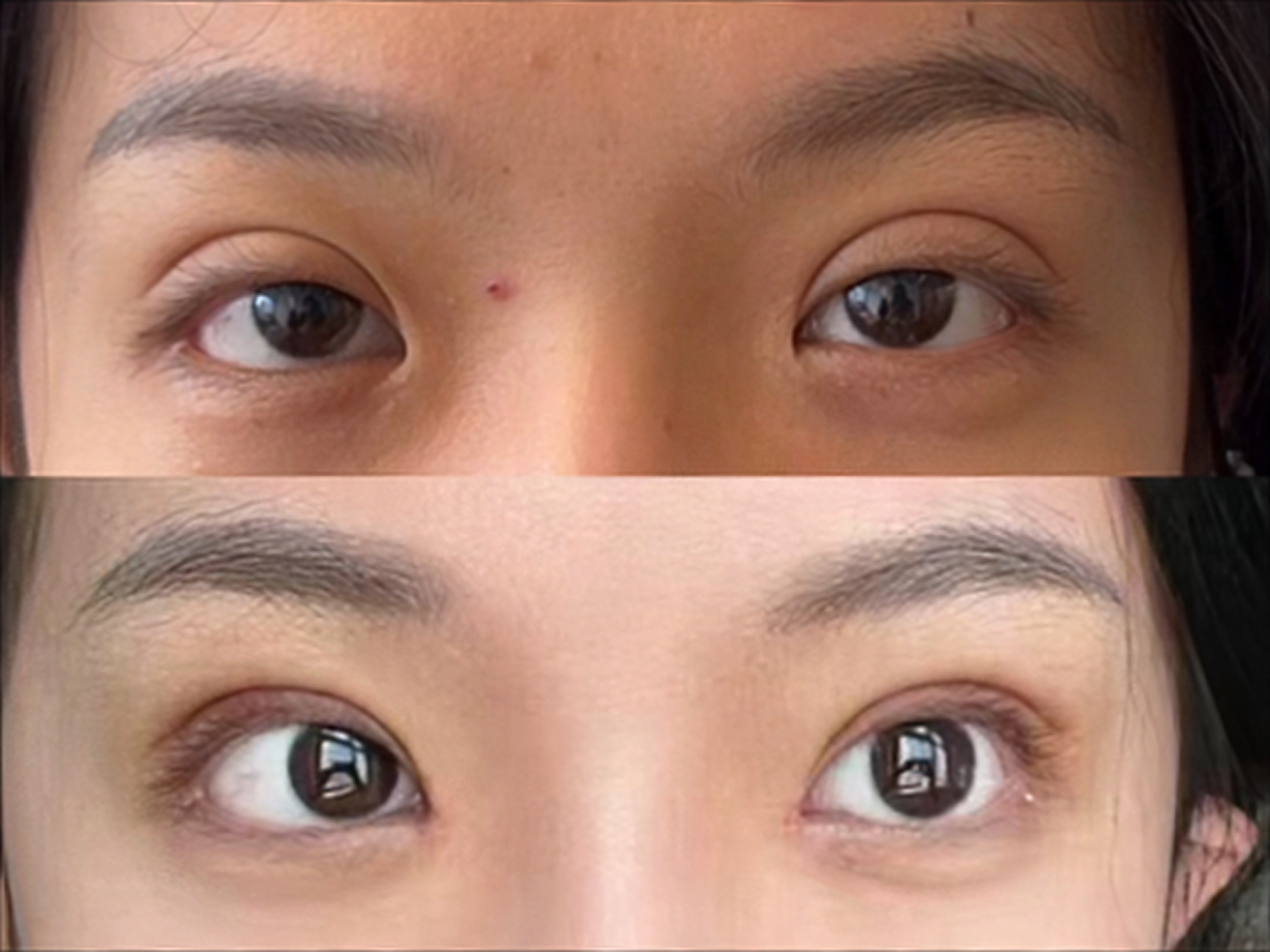 肉条吗双眼皮宽改窄图片对比图眼睛凸窄双眼皮双眼皮注射加宽效果图