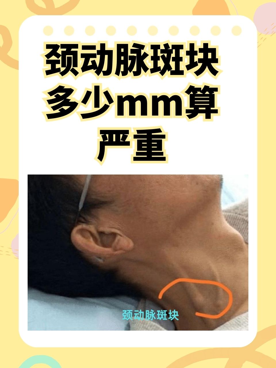 颈动脉斑块多少mm算严重?