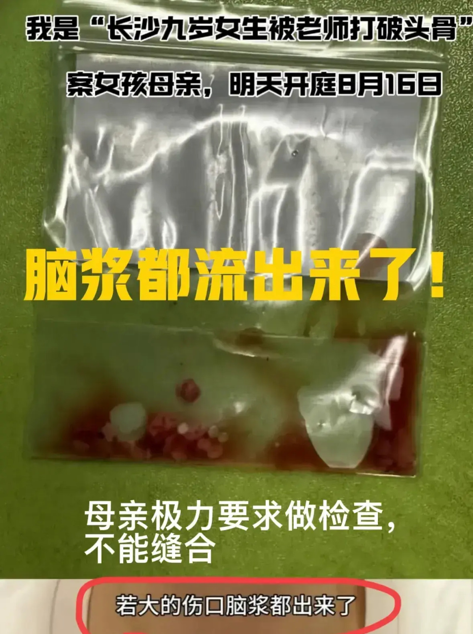 9岁女童被老师打碎头骨,脑浆流出!一年后醒来说出实情