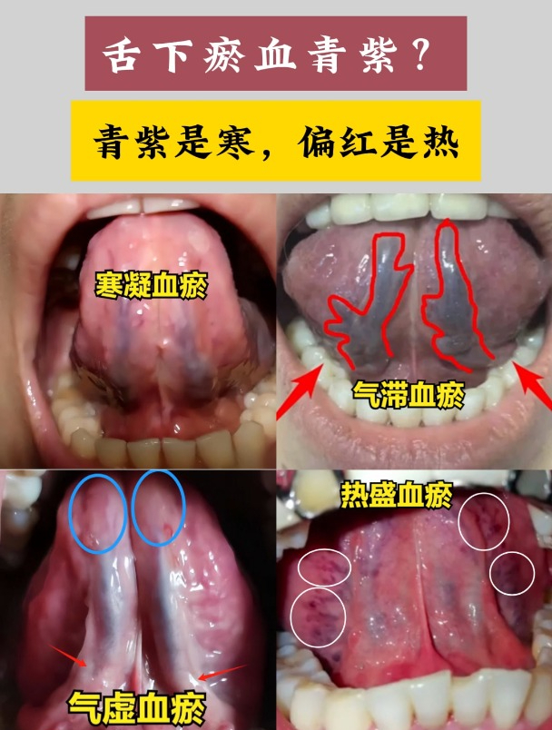 血瘀舌头图片比对图片