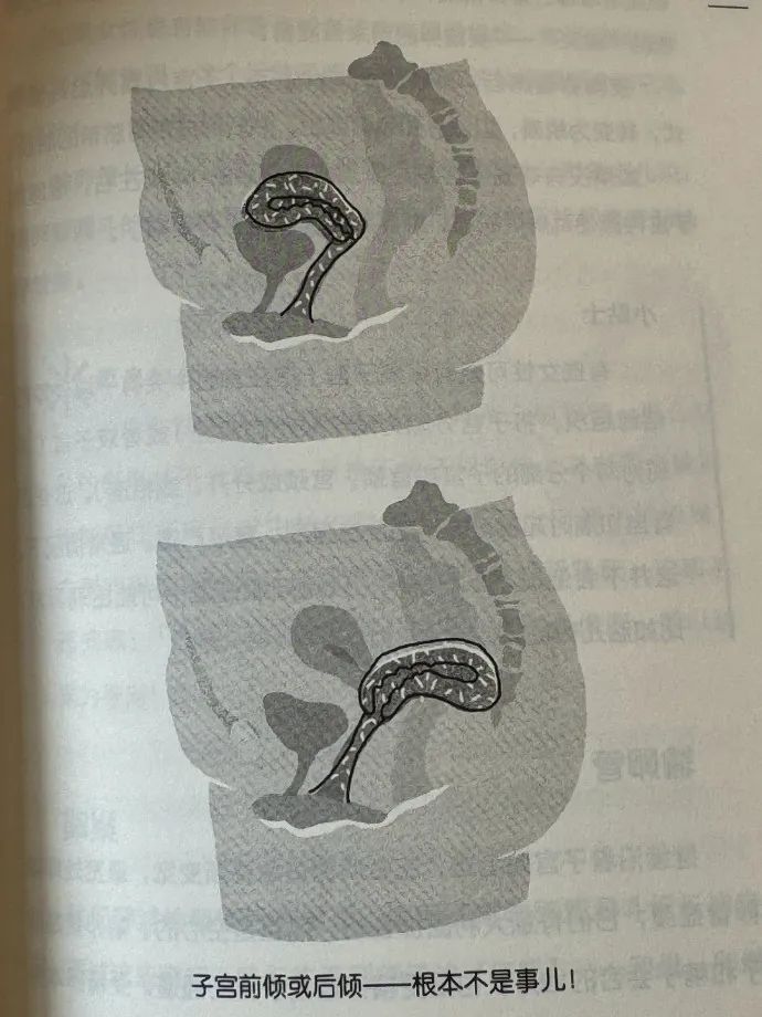 体检医生说我子宫后倾，原来长这样（图）