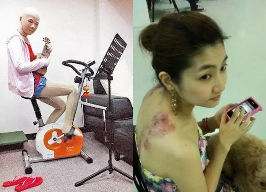 "让伤痕变铠甲",任家萱烧伤14年,靠跑步找回了信心