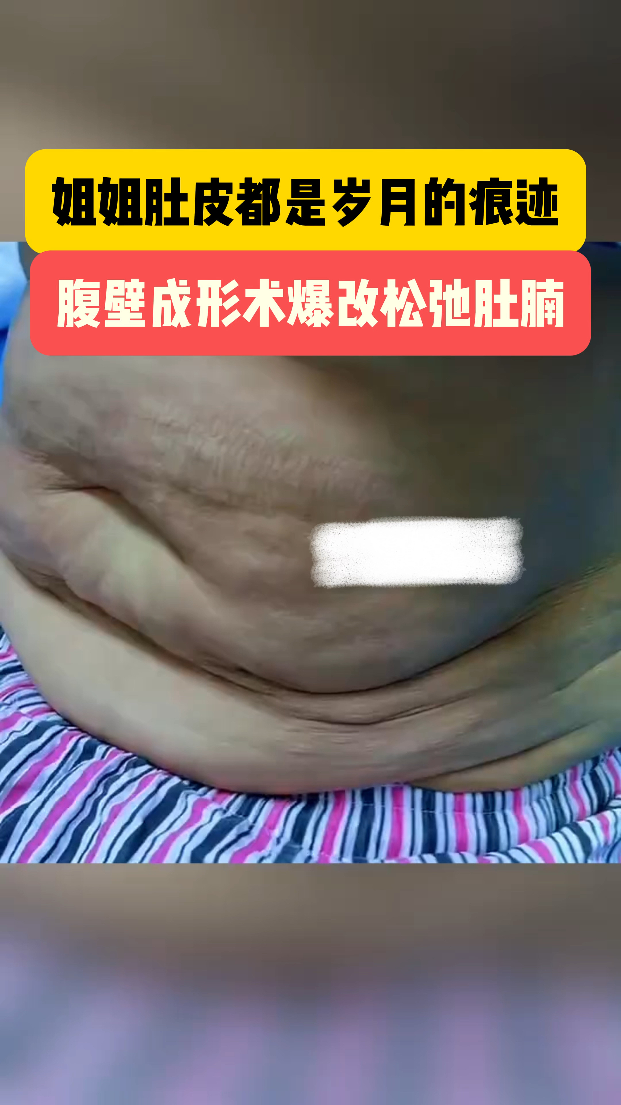 减肥后肚皮松弛的照片图片