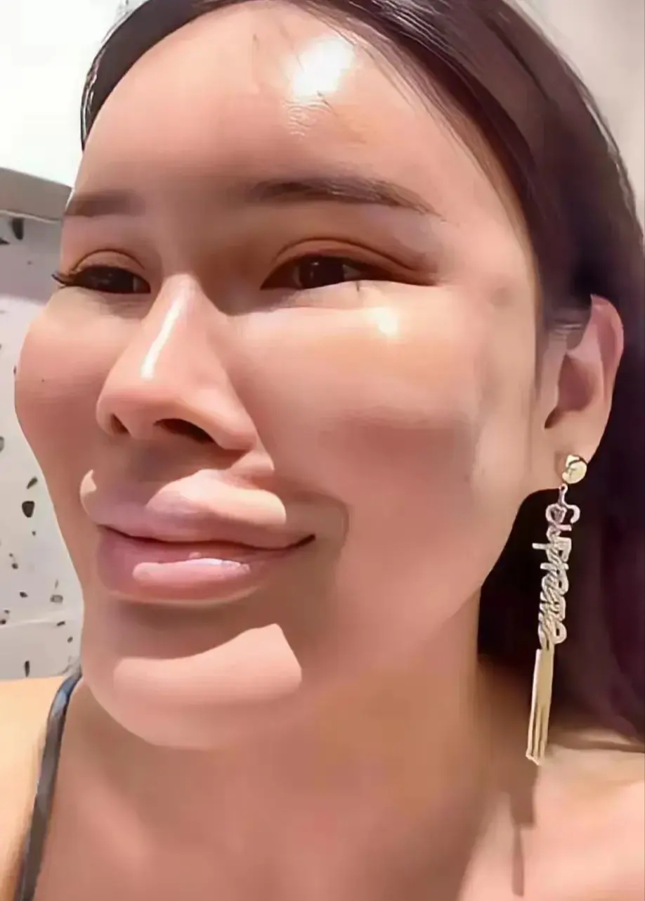 朋友亲戚都说她整容失败了,但是医护人员却坚称手术很成功,达到了女生