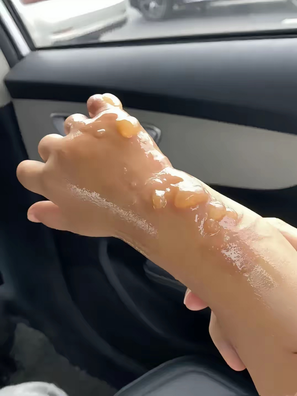 真的心疼死了,孩子今天不小心被开水烫伤,起了好多水泡,第一时间该