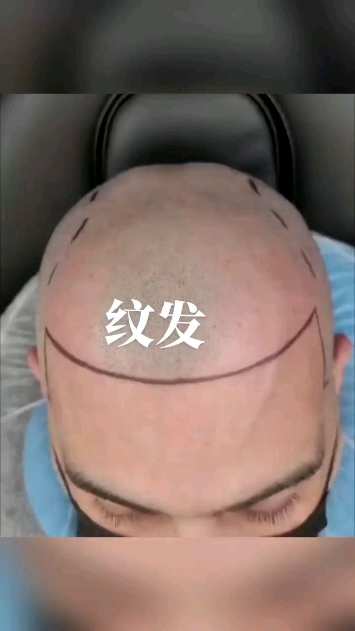 纹发 纹发际线纹鬓角