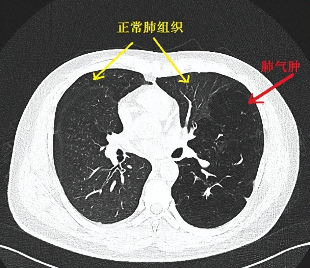 先天性大叶性肺气肿图片