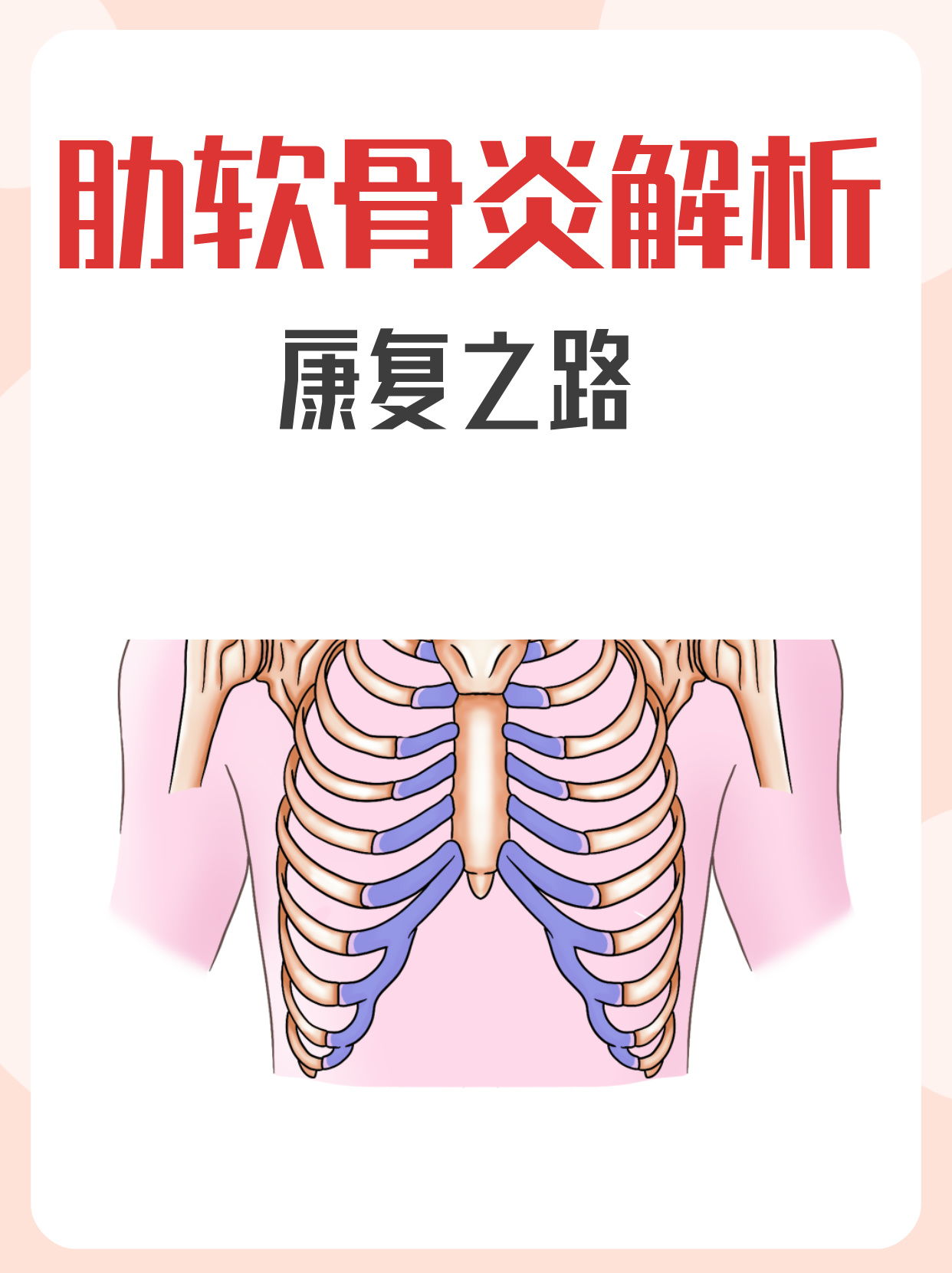 肋软骨炎示意图图片