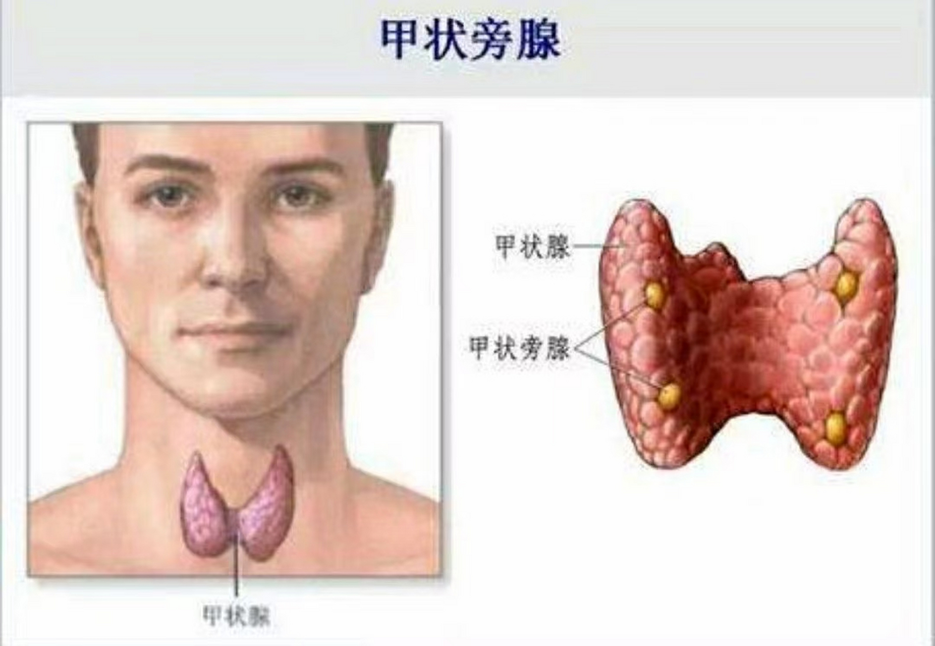 甲状旁腺声像图表现图片