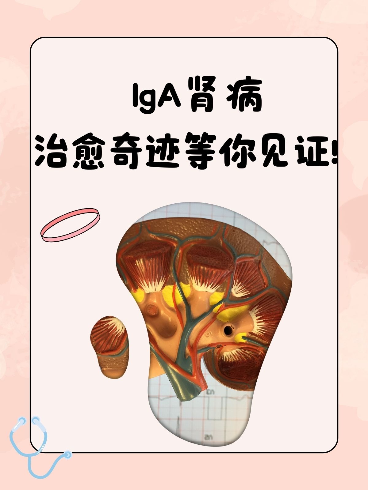 iga肾病是一种较为常见的肾脏疾病