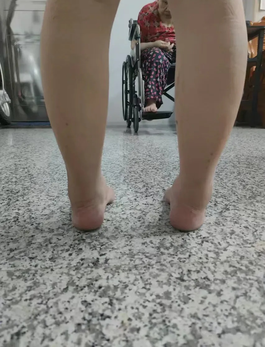 网友:医生,我知道自己有足内翻,从十几岁就知道了,现在这个年龄,想