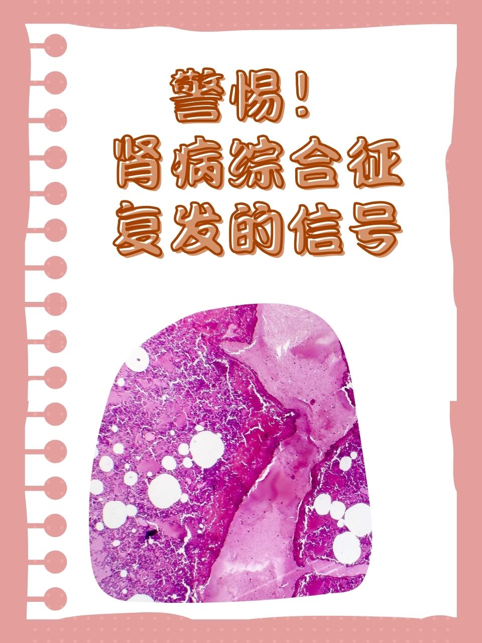 很多患者对于肾病综合征复发的迹象并不清楚,往往在病情复发后才有所