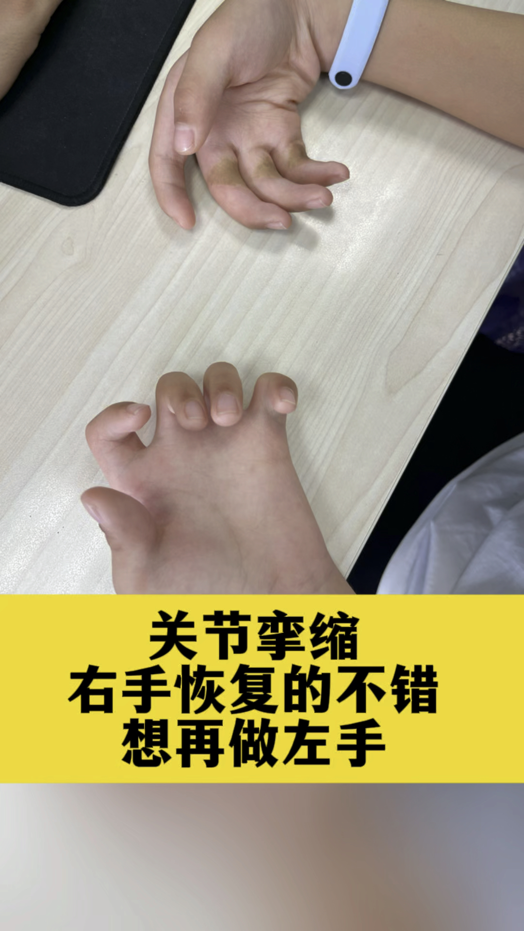 手指伸不直,右手恢复的不错
