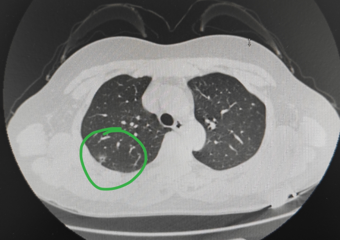 肺磨玻璃结节6mm图片