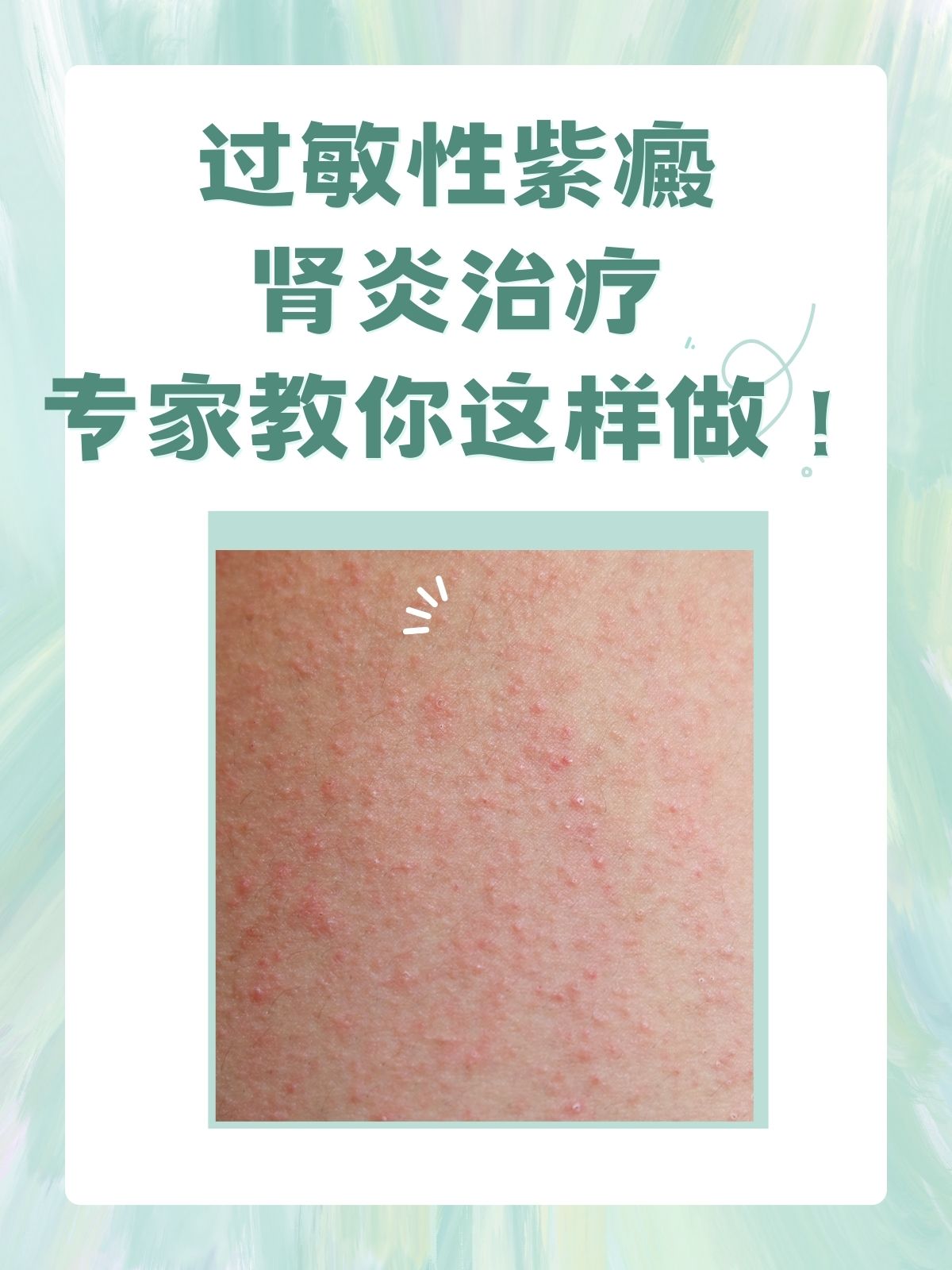 过敏性紫癜肾炎治疗,专家教你这样做!