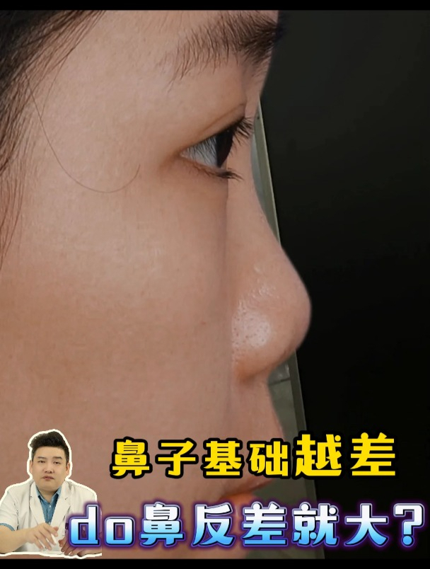 鼻子基础越差,do鼻反差就大?