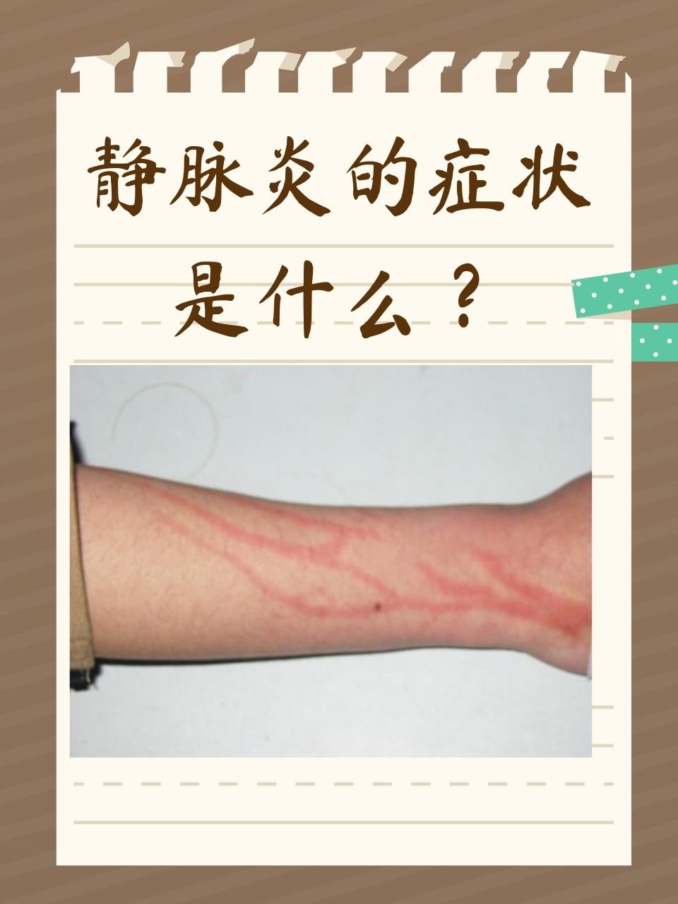 静脉炎的症状是什么?