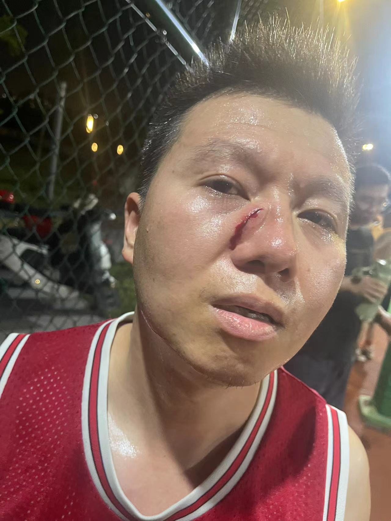 图片打篮球受伤图片轻伤孩子打篮球脸上受的伤被篮球炸到的伤口的照片