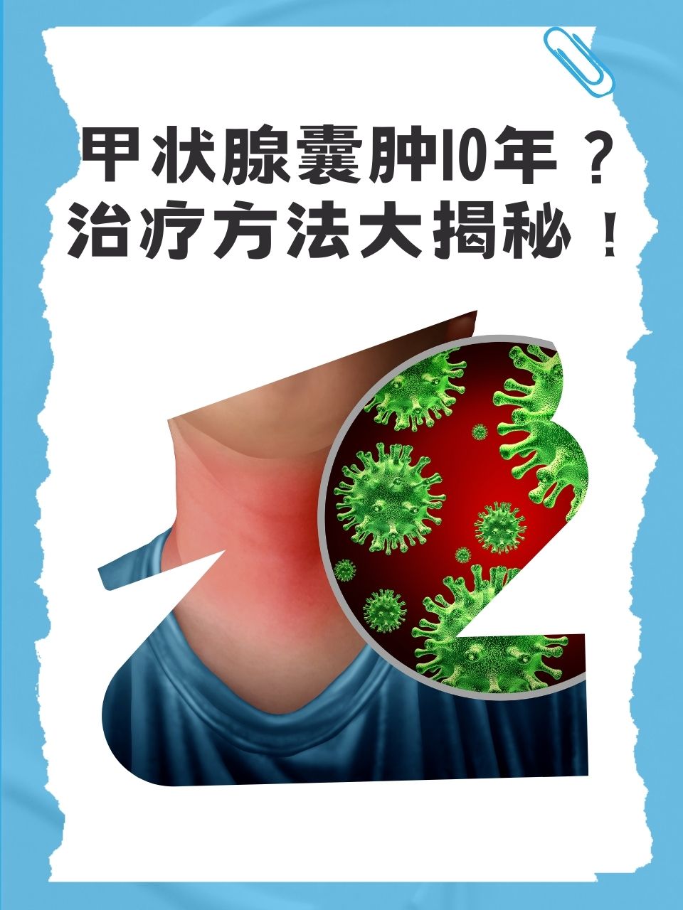 甲状腺囊肿作为一种常见的甲状腺疾病,可能在不知不觉中陪伴患者多