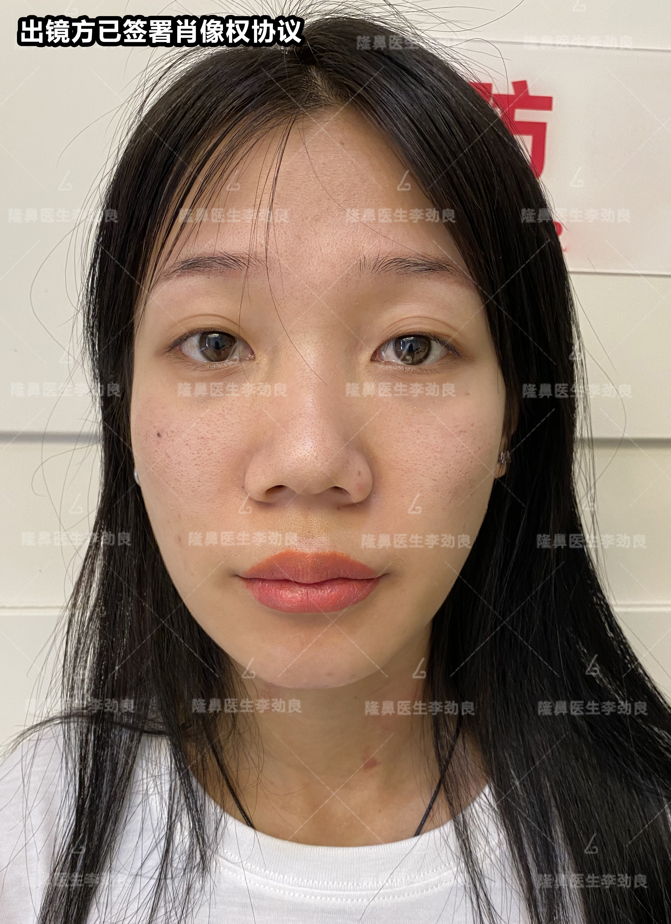 现在还没有拆线但看了刚做完的照片