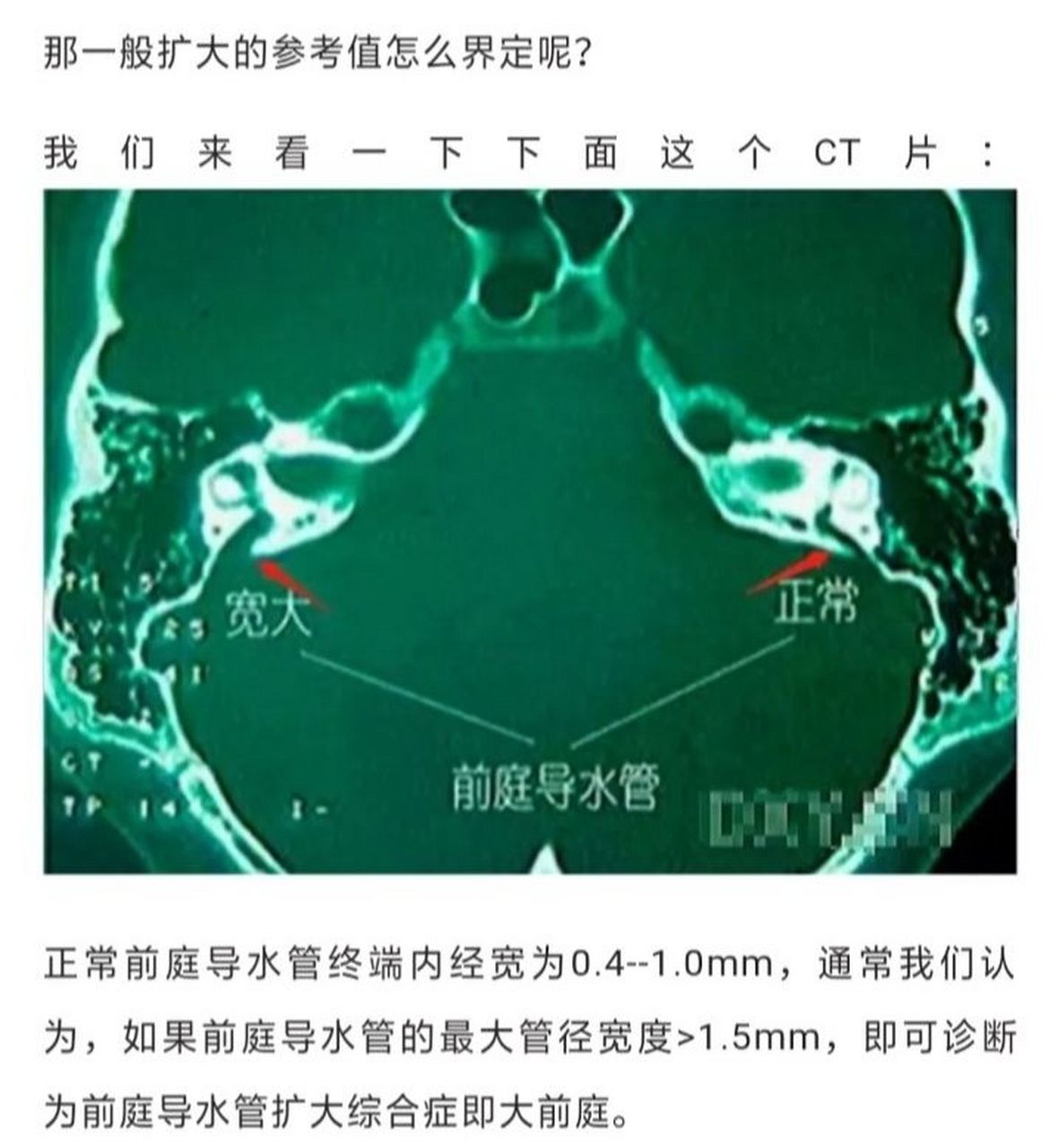 1早发现早预防确诊大前庭的途径有影像学检查