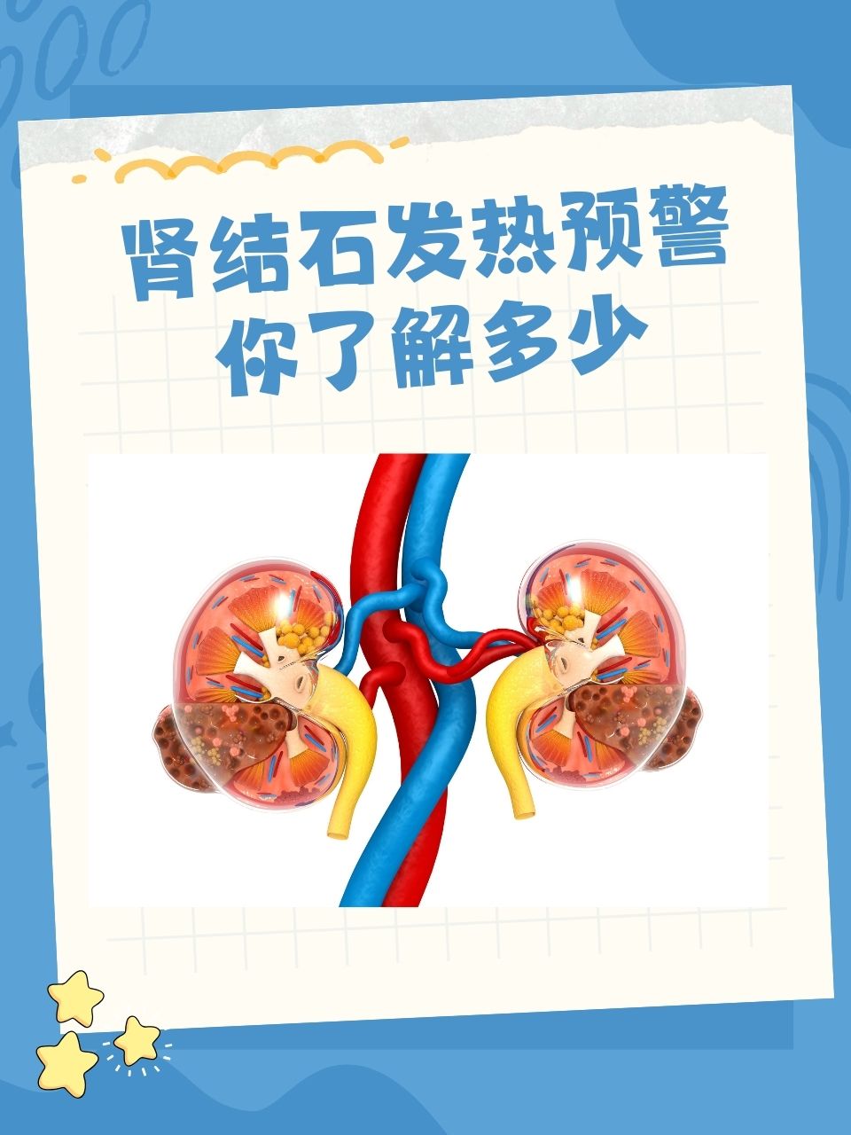为什么会得肾结石