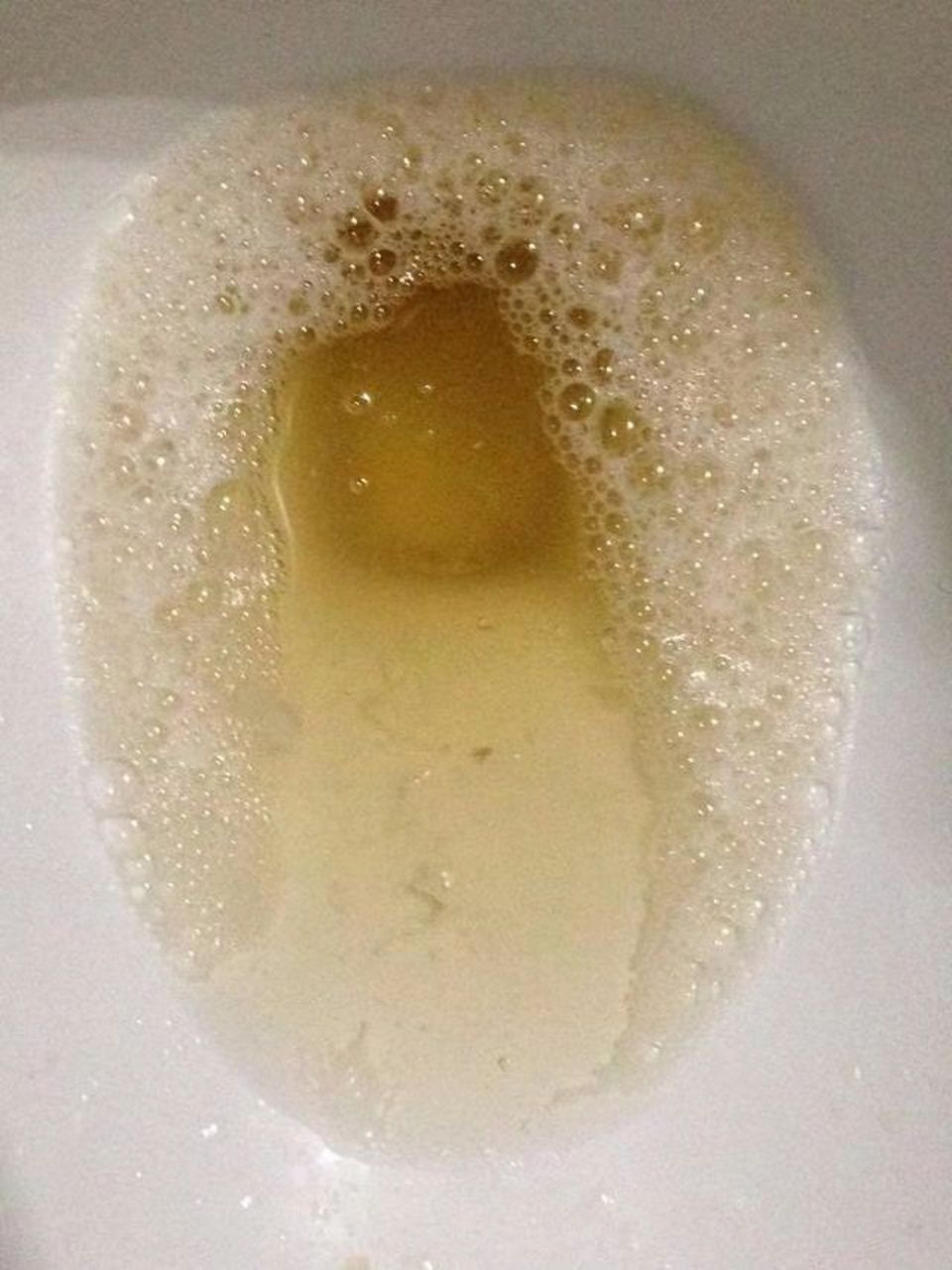 患者李先生,64岁,三年前因身体水肿和尿液泡沫增多被确诊为慢性肾小球