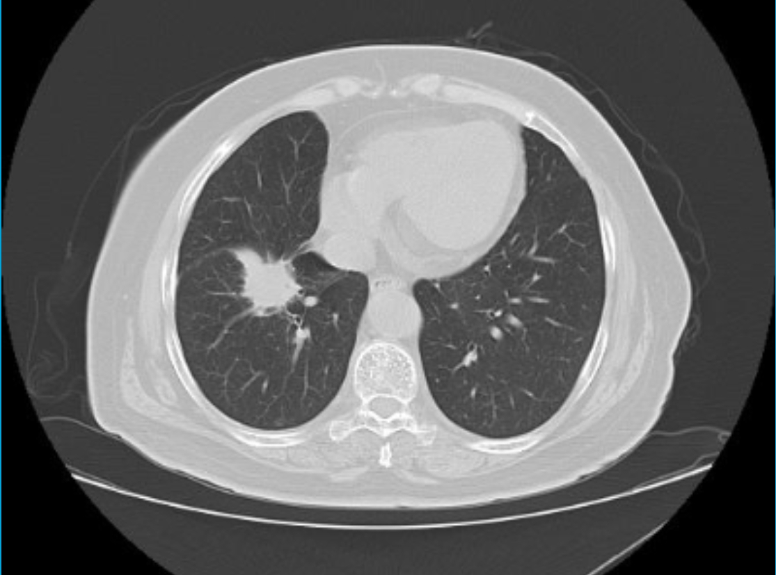 正常肺部ct图恶性肿瘤图片