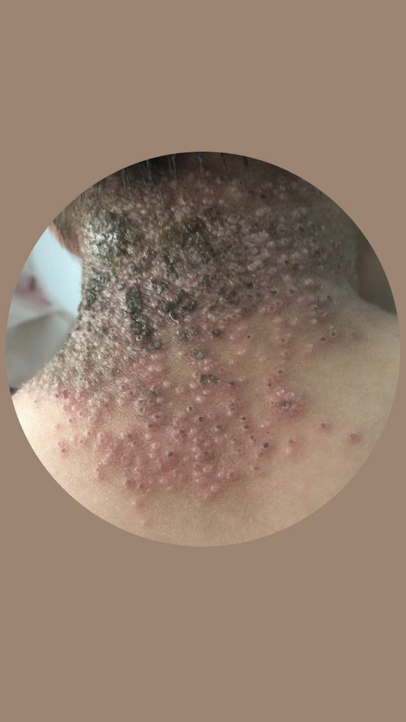 容易误诊为水痘的卡波西水痘样疹