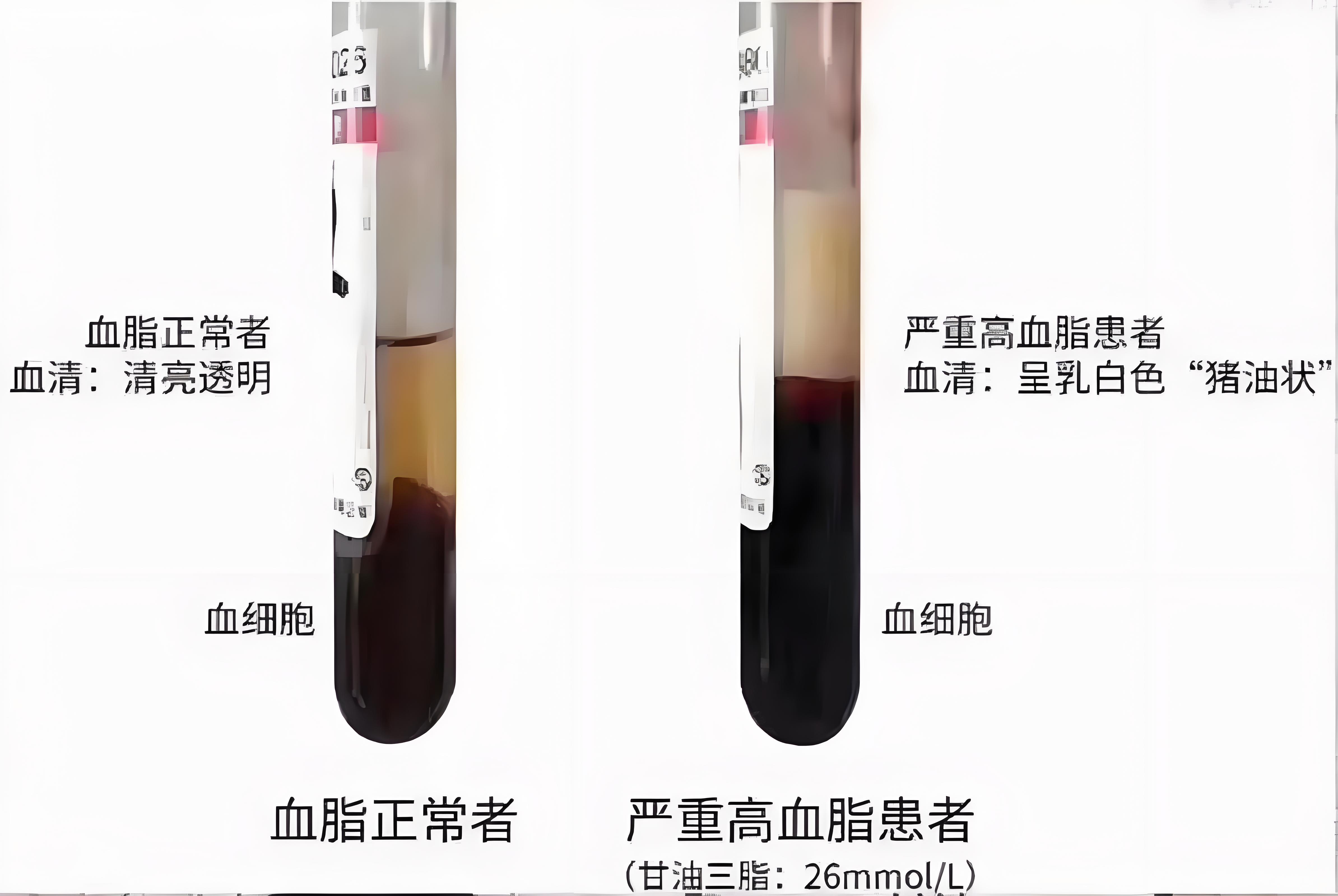 什么情况下血液会变成白色   20岁小伙只喝奶茶饮料成牛奶血