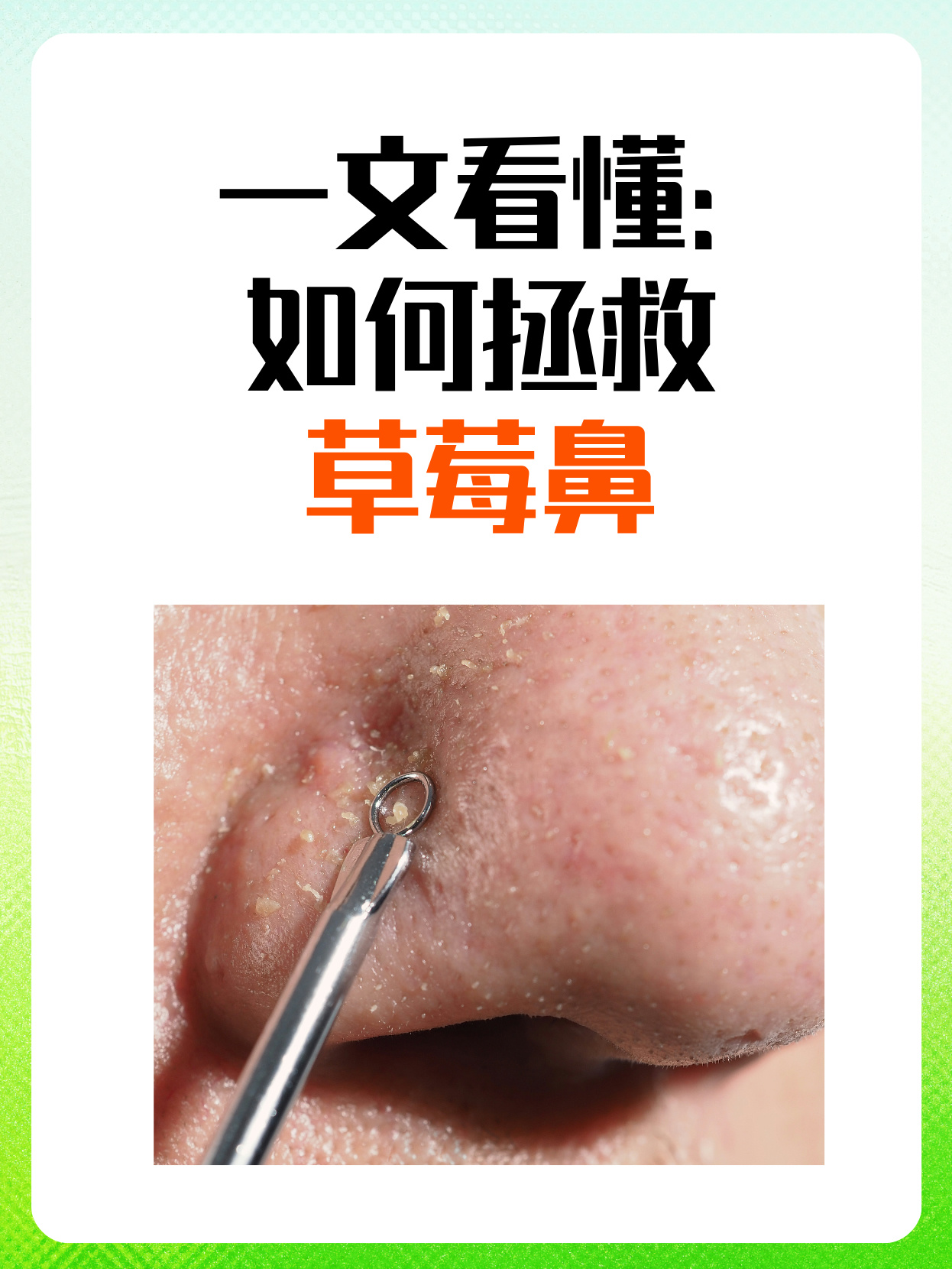 草莓鼻一般是指黑头,可以通过以下方法去除: 美容