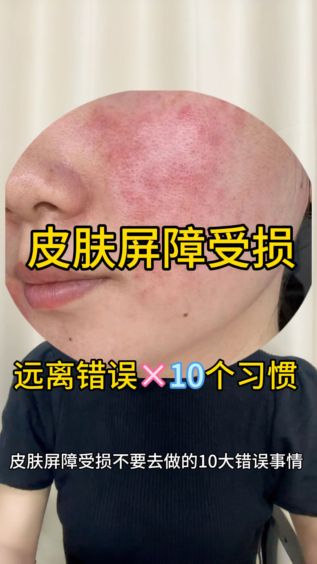 激素脸屏障受损,想要修好,远离这10个错误的习惯