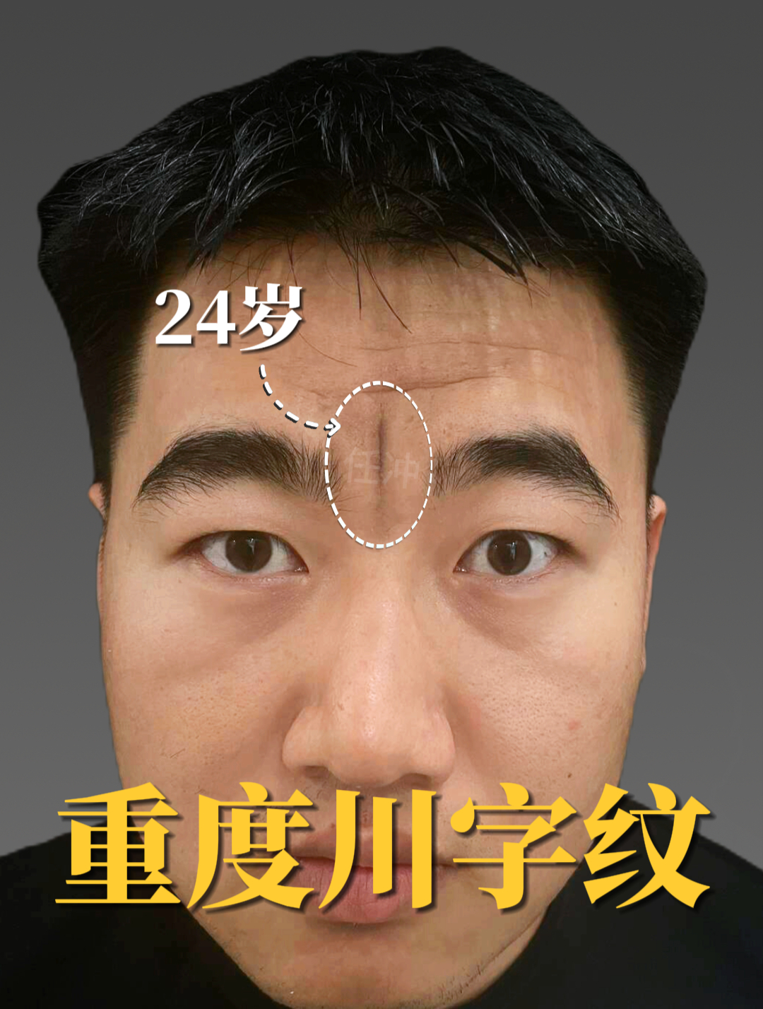 24岁,这么重的川字纹,你见过吗?
