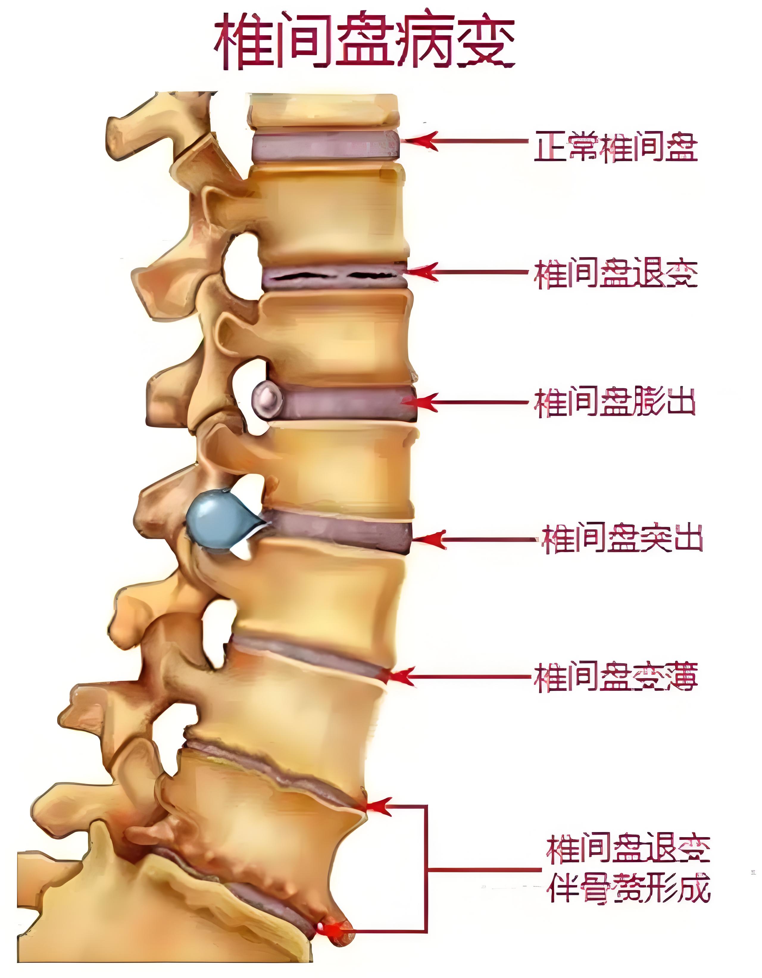 腰椎间盘突出症的15种症状