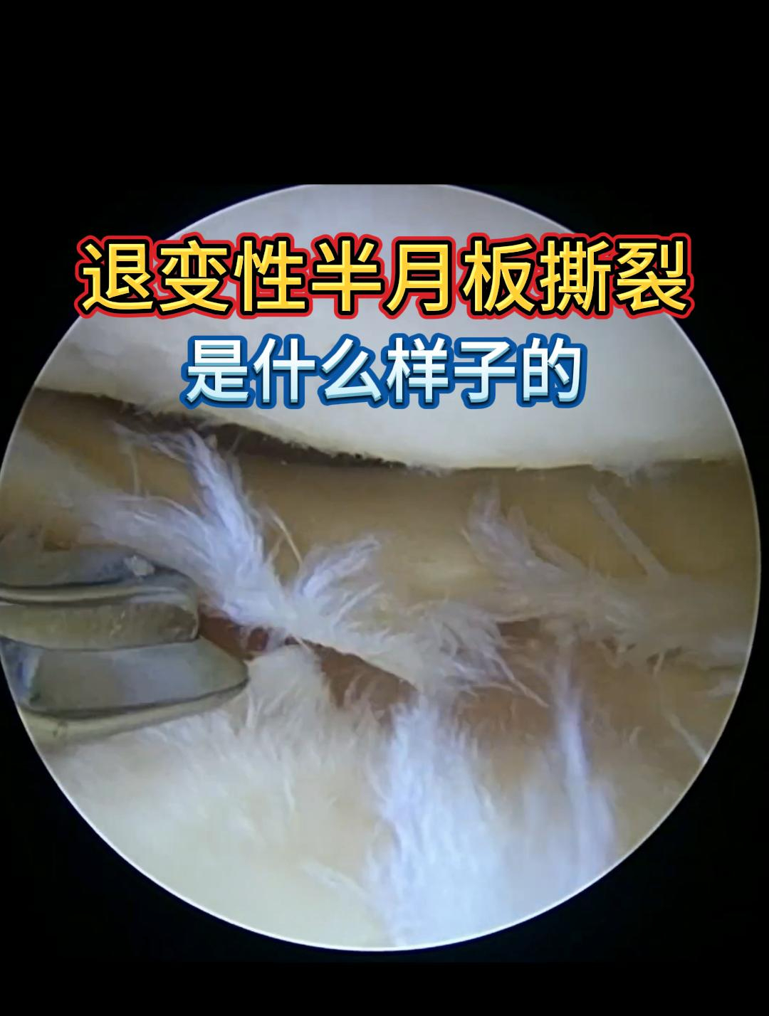 老年人退变性半月板撕裂是什么样子的?