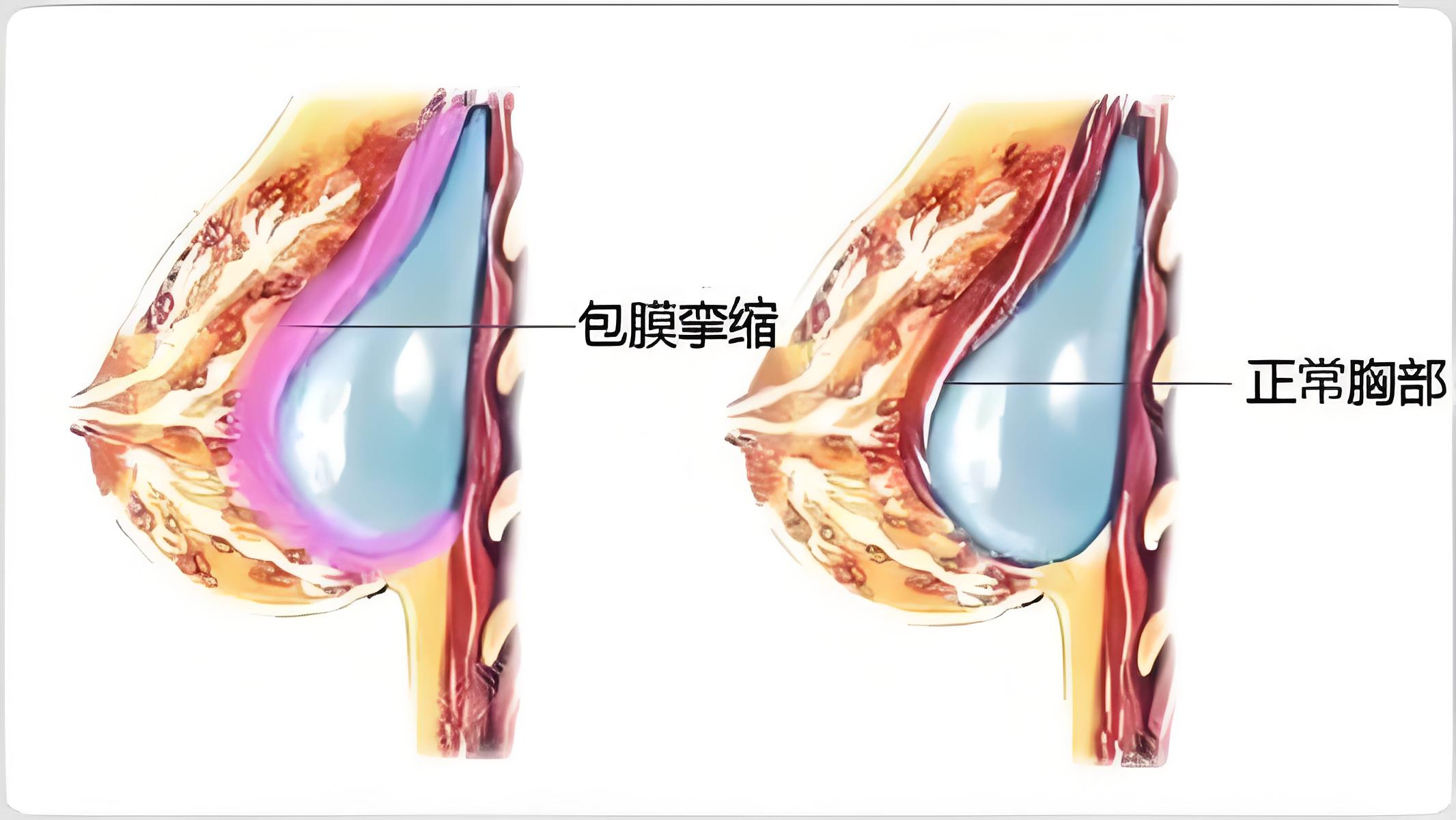 假体隆胸按摩手法图图片