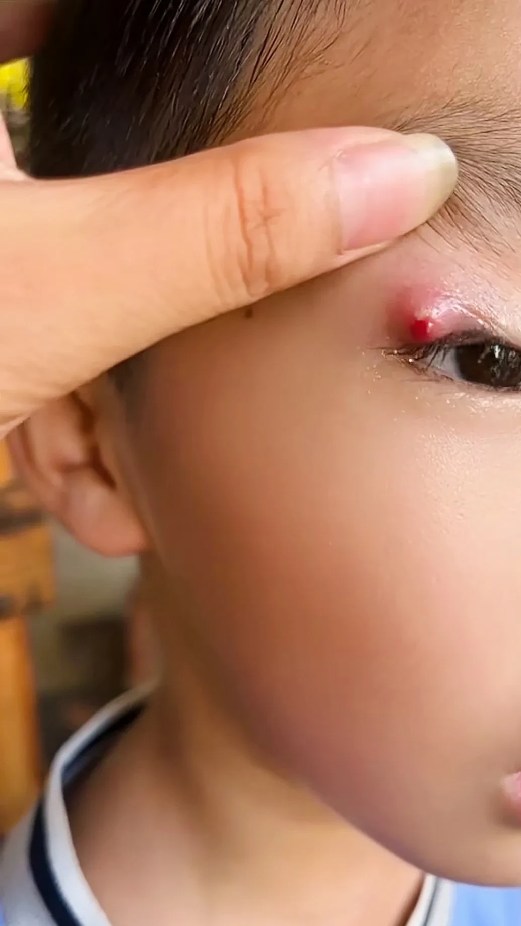 眼睛长息肉怎么办手术几天能好眼角起了一个疙瘩还肿了疼咋回事眼毛囊