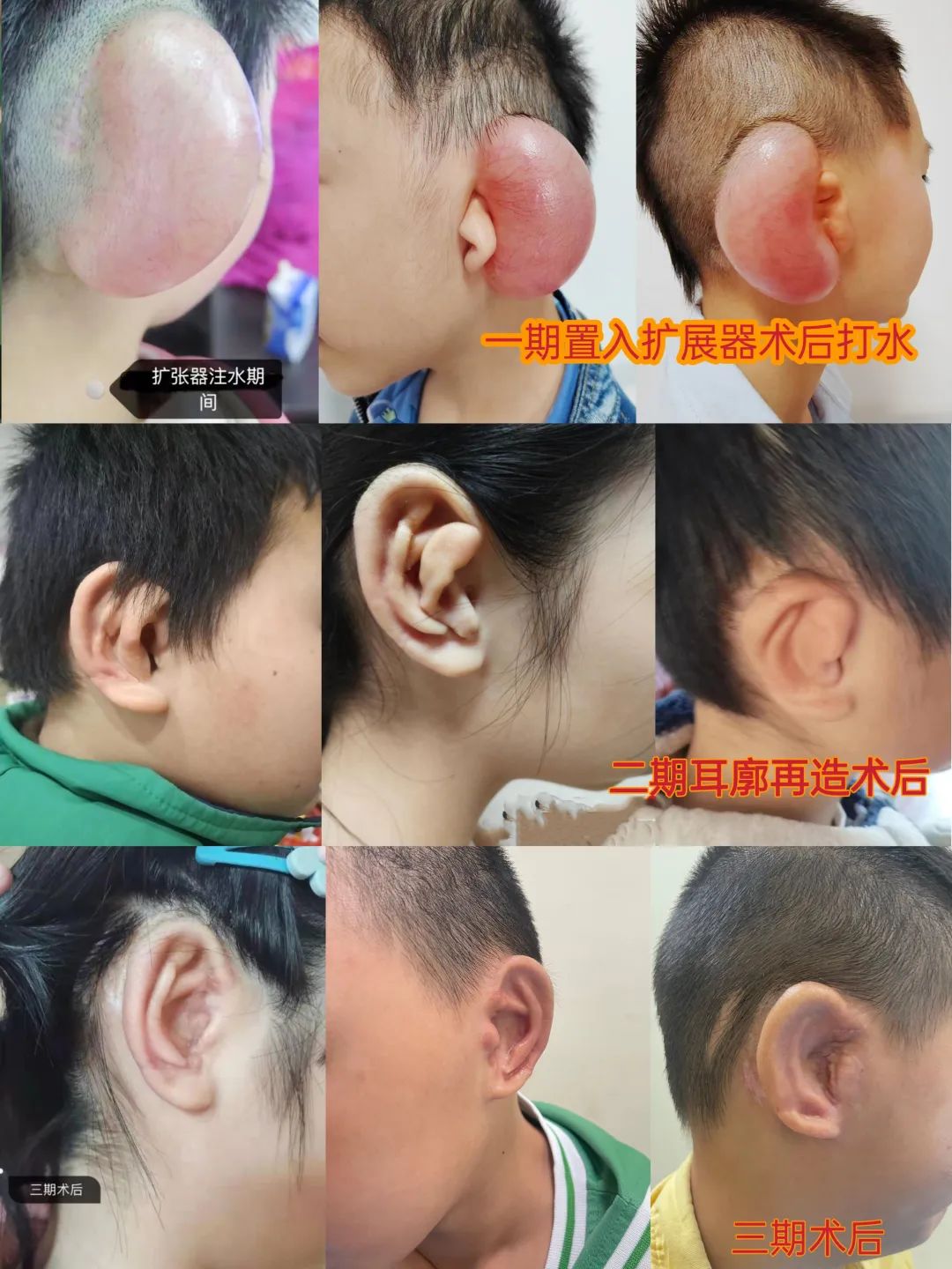 神奇耳再造术让6名先天性小耳畸形患儿"长出"新耳朵