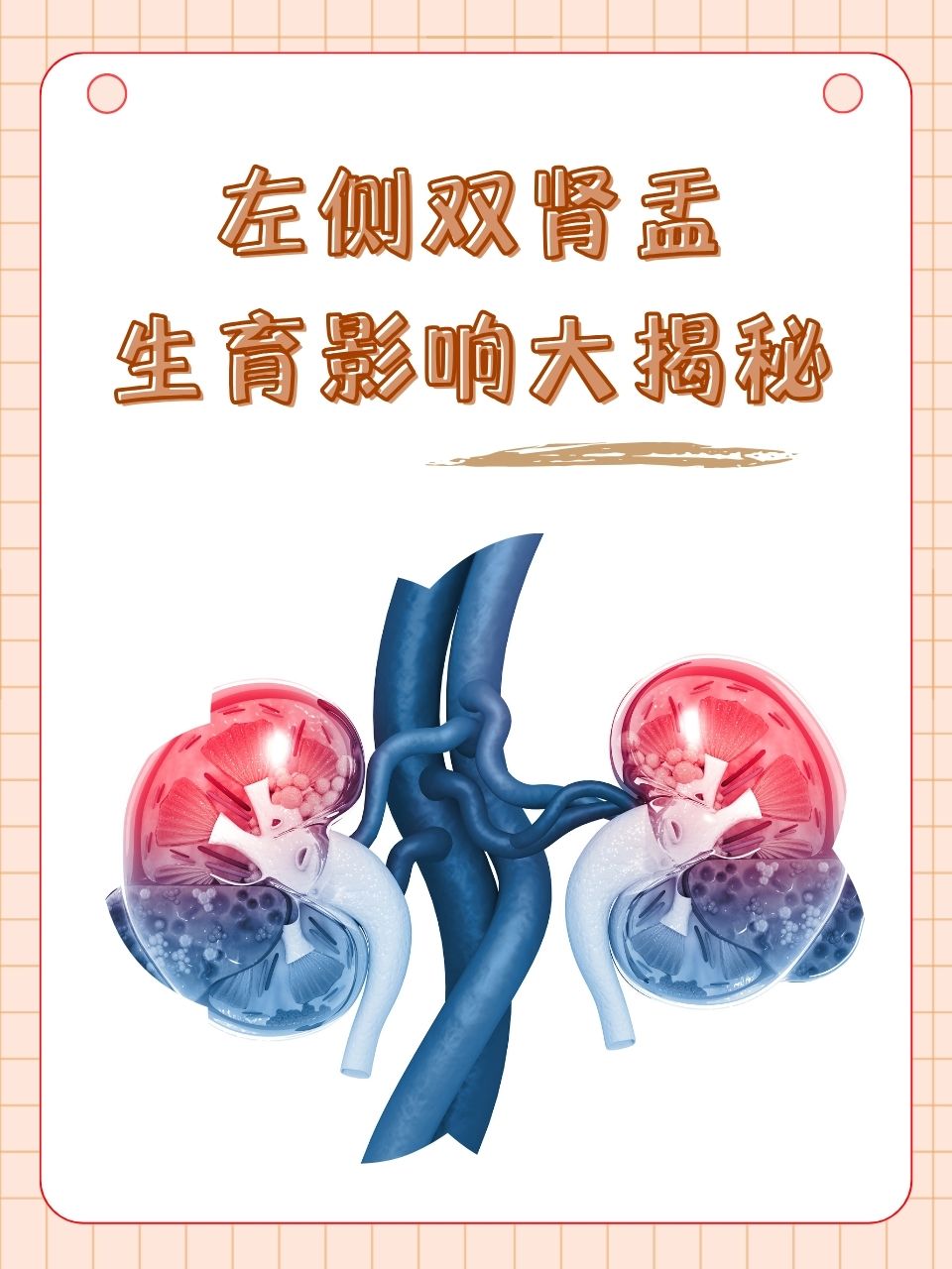 左侧双肾盂,生育影响大揭秘