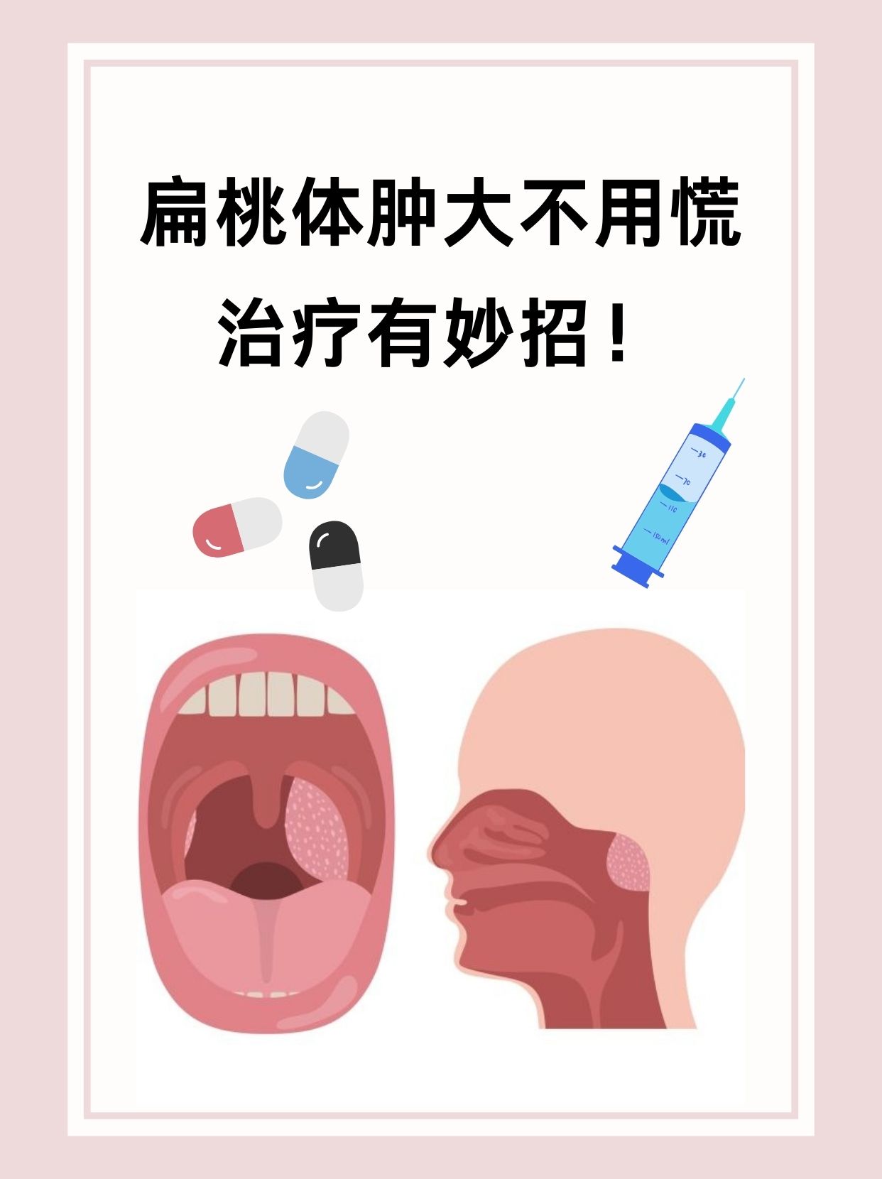 扁桃腺炎症图片