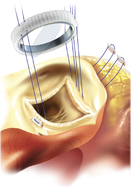 心脏瓣膜置换发展史?瓣膜的分类?适合人群?并发症?注意事项?