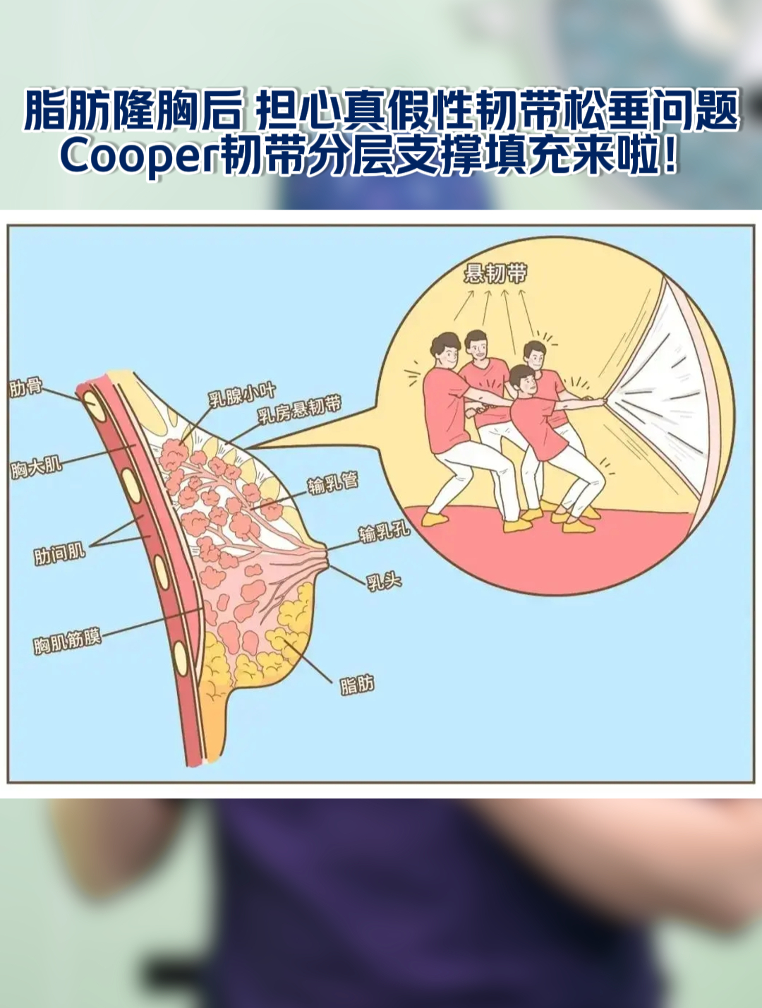 cooper韧带悬吊术图片