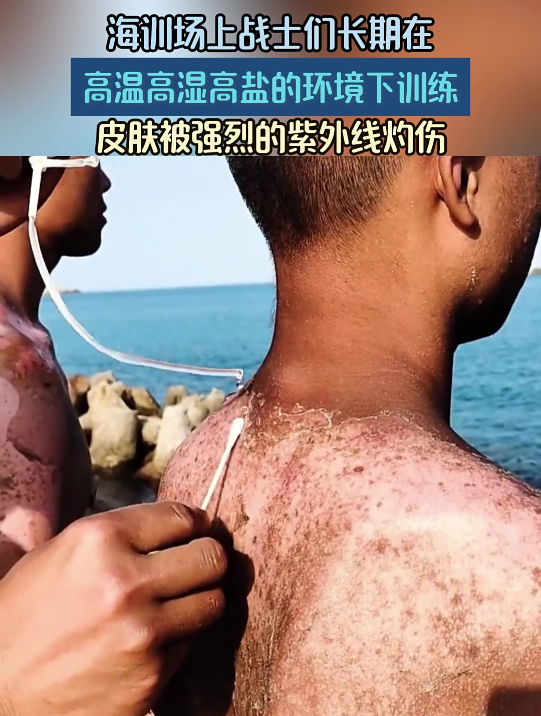 海训场上战士们长期在高温高湿高盐的环境下训练皮肤被紫外线灼伤